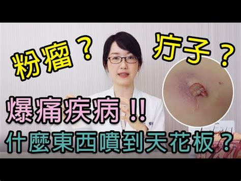 臉上釘子|「長釘子」別亂擠！疔瘡是什麼？會自己好嗎？原因及。